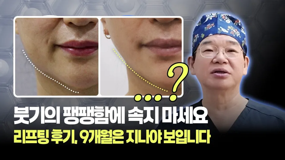 리프팅시술 9개월 후 진짜 라인과 효과를 확인하는 방법