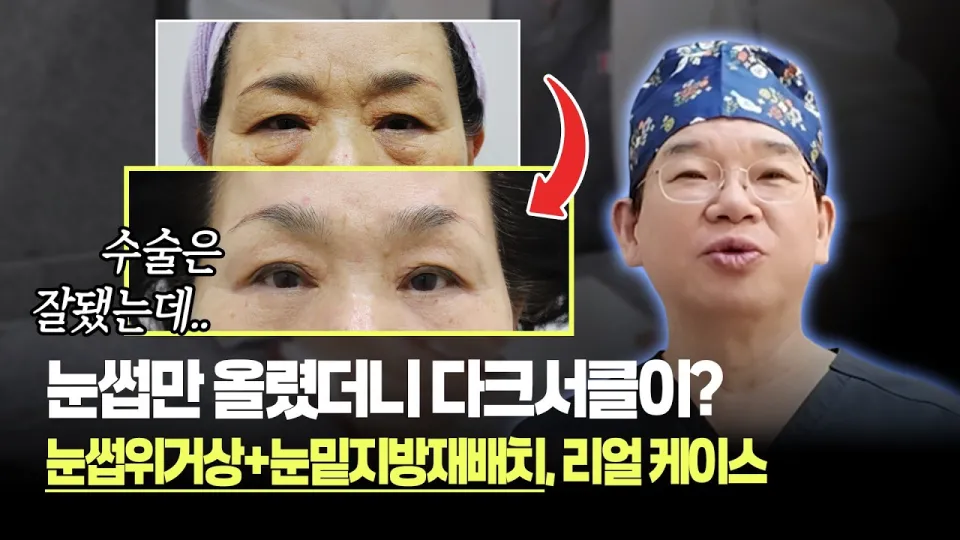 눈썹위거상은 처진 눈썹과 눈밑 그늘을 효과적으로 개선하여 자연스러운 눈매를 만들어줍니다
